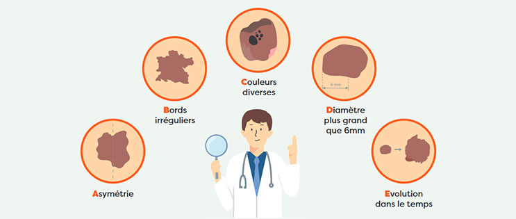 Infographie Mélanome ABCDE
