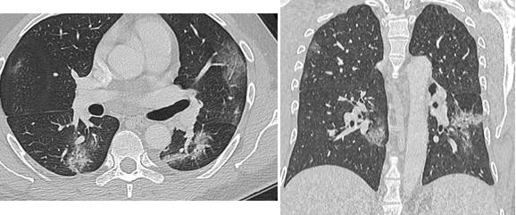 Covid 19 - figure 2b