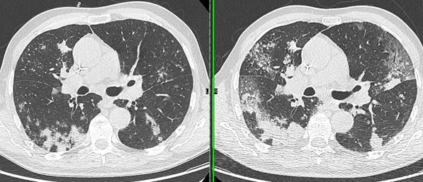 Covid 19 - figure 3