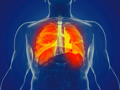 fibrose pulmonaire 